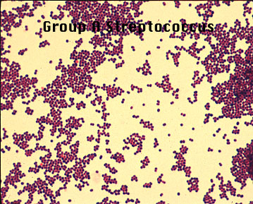 group a beta hemolytic streptococcus