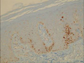 The skin of a psoriasis patient was treated with phototherapy (UV light) thrice a week for 6 weeks. The darker cells show the expression of mutant p53 gene, an early marker for skin cancer. Phototherapy of psoriasis might increase the risk of skin cancer development. (Dr. Allal Ouhtit)