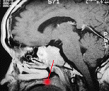 Clivus Brain