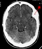 Ct+scan+of+brain+without+contrast
