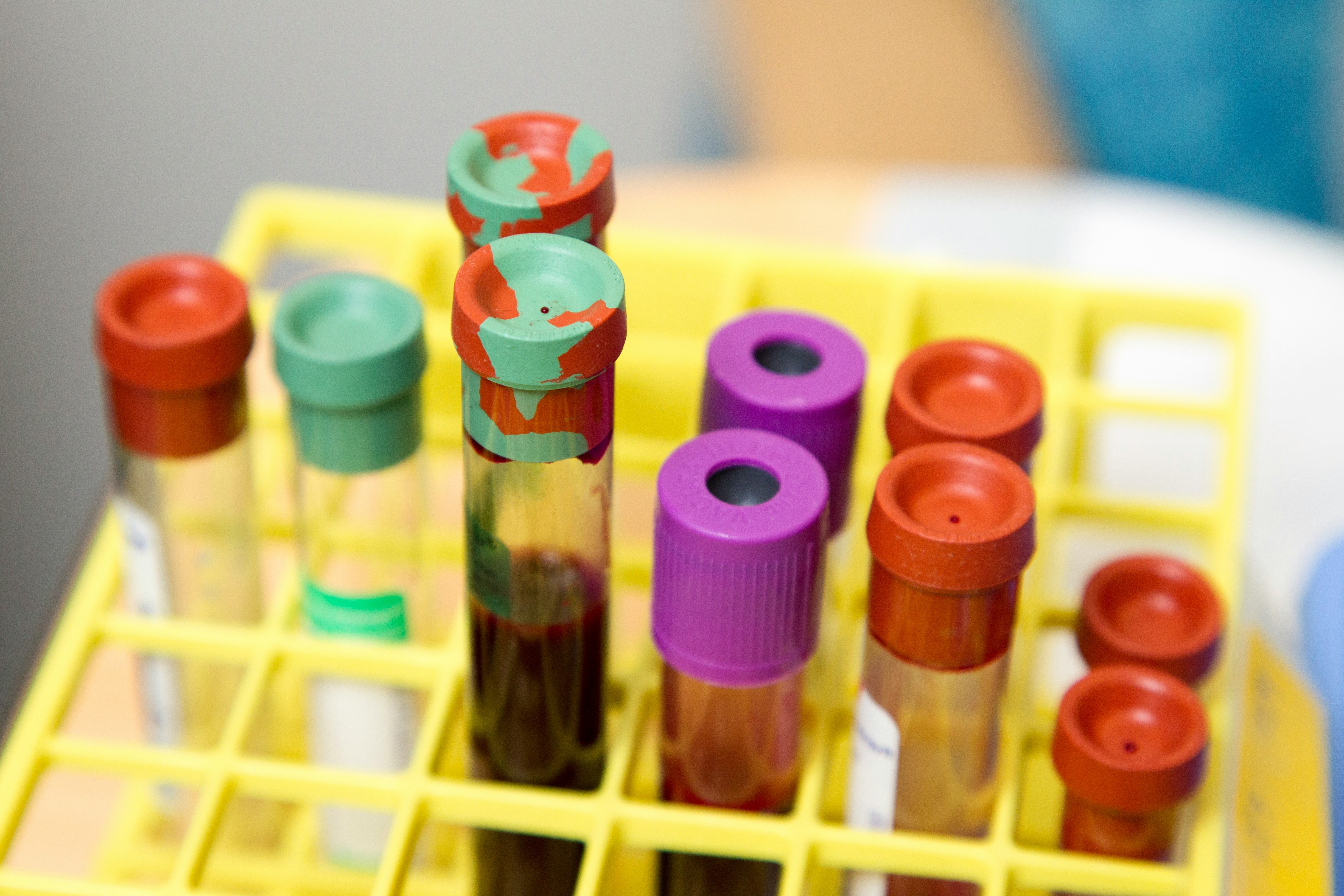 Close-up of blood sample vials with colored caps in a yellow plastic test tube rack, used for laboratory testing and diagnostics.