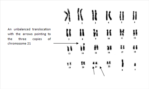 Trisomy Diagram