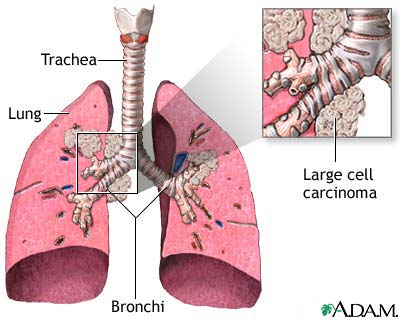 large cell carcinoma