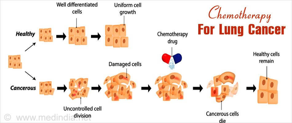 lung-cancer-treatment-chemotherapy