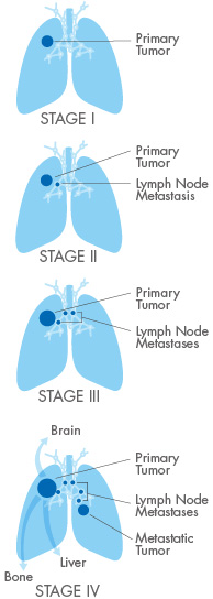 NSCLC_Staging_Graphic_for_Web-01