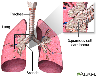 squamous cell carcinoma