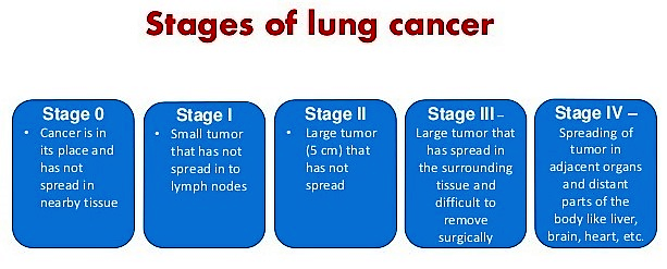 Stages Of Lung Cancer Chart