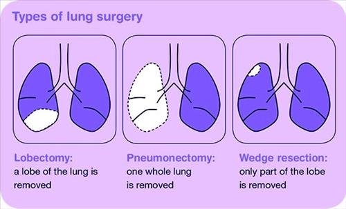 Types-of-lung-surgery-2copy