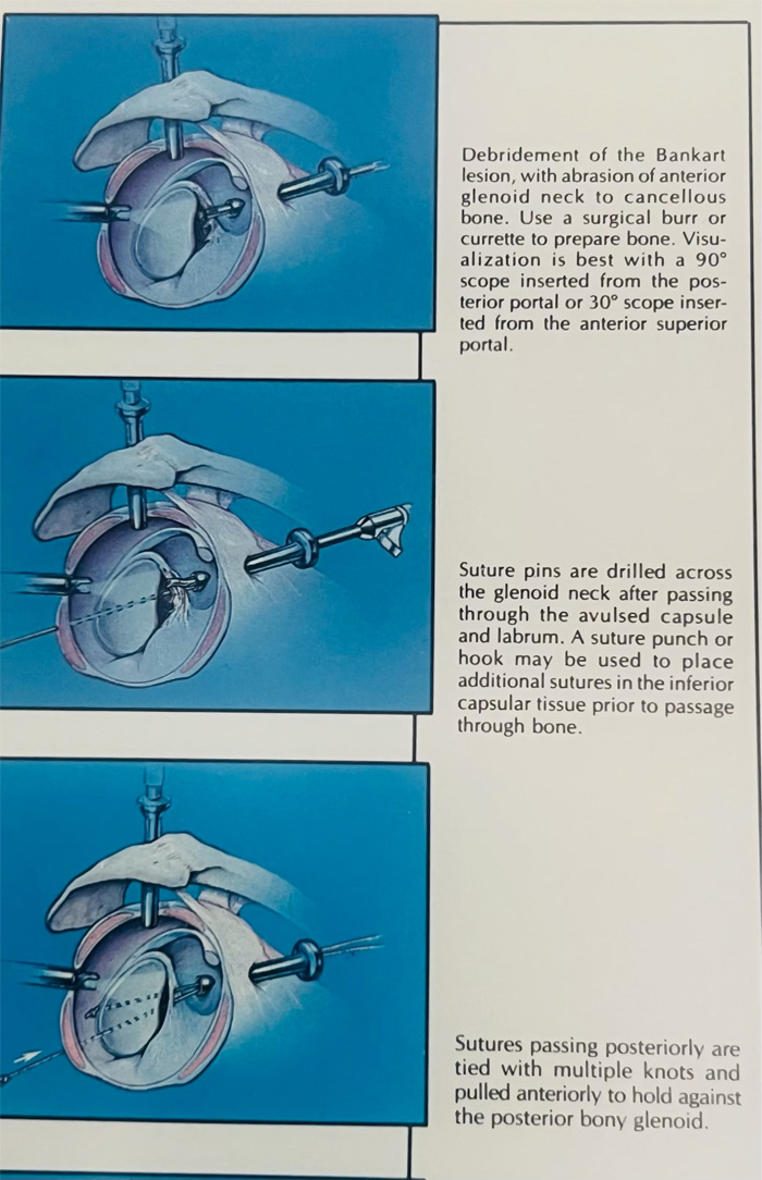 Dr. Neil Makis Bankart Suture Repair Published in AAOS April 1990 P2