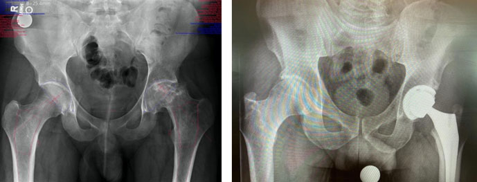 Before and after Outpatient Total Hip Arthroplasty 