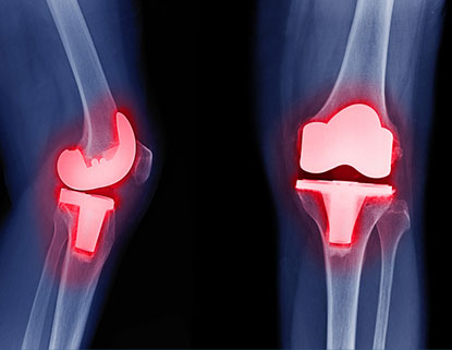 TKA knee x-ray