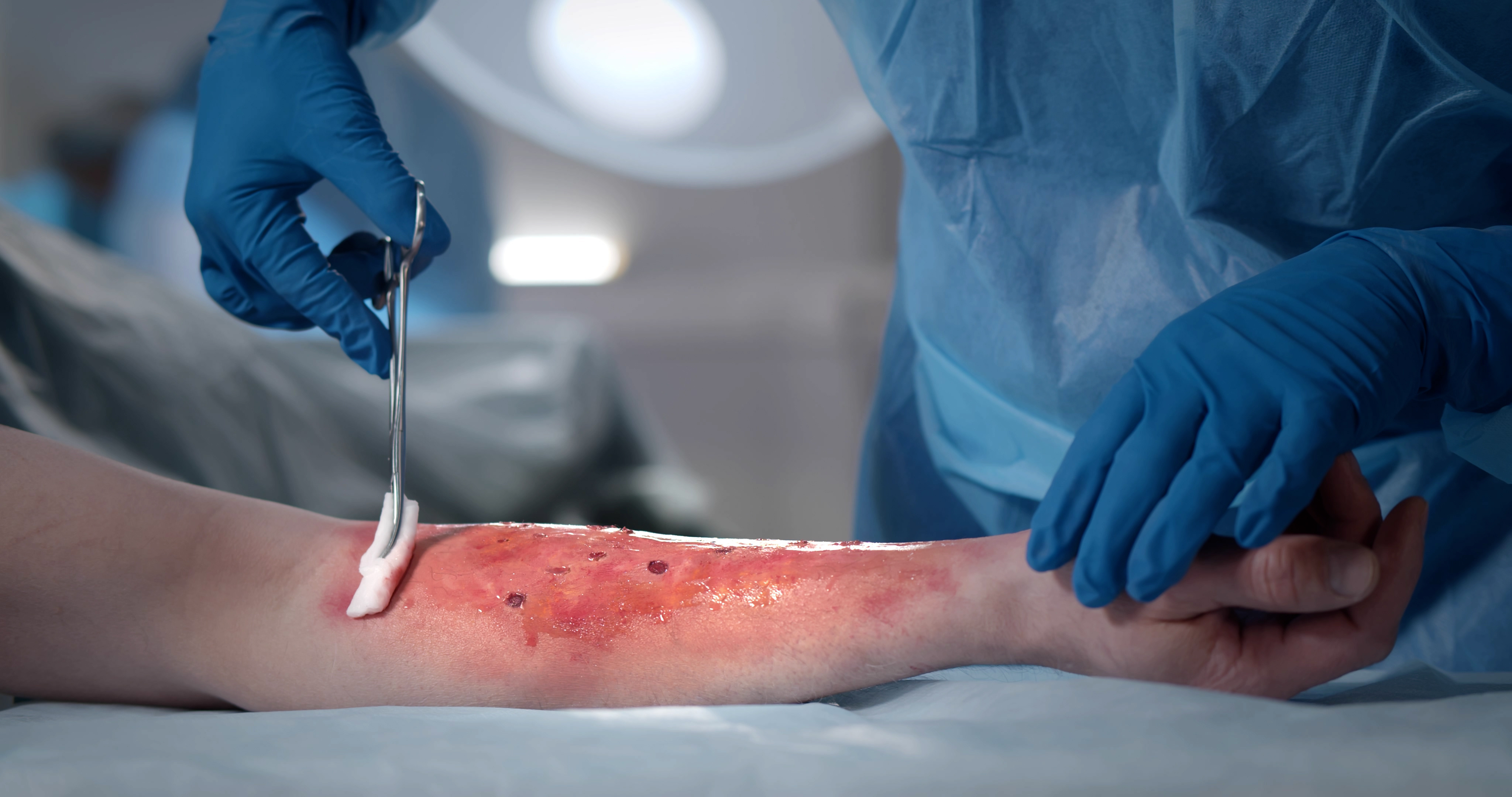 Surgeons team working with burn wound on arm of patient in operating room